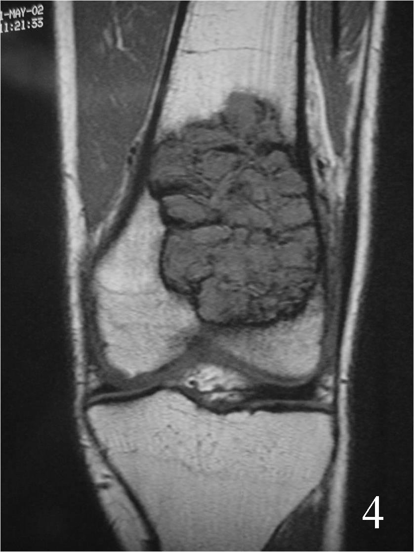 Giant Cell Tumor Of Bone Bone Tumors 0285